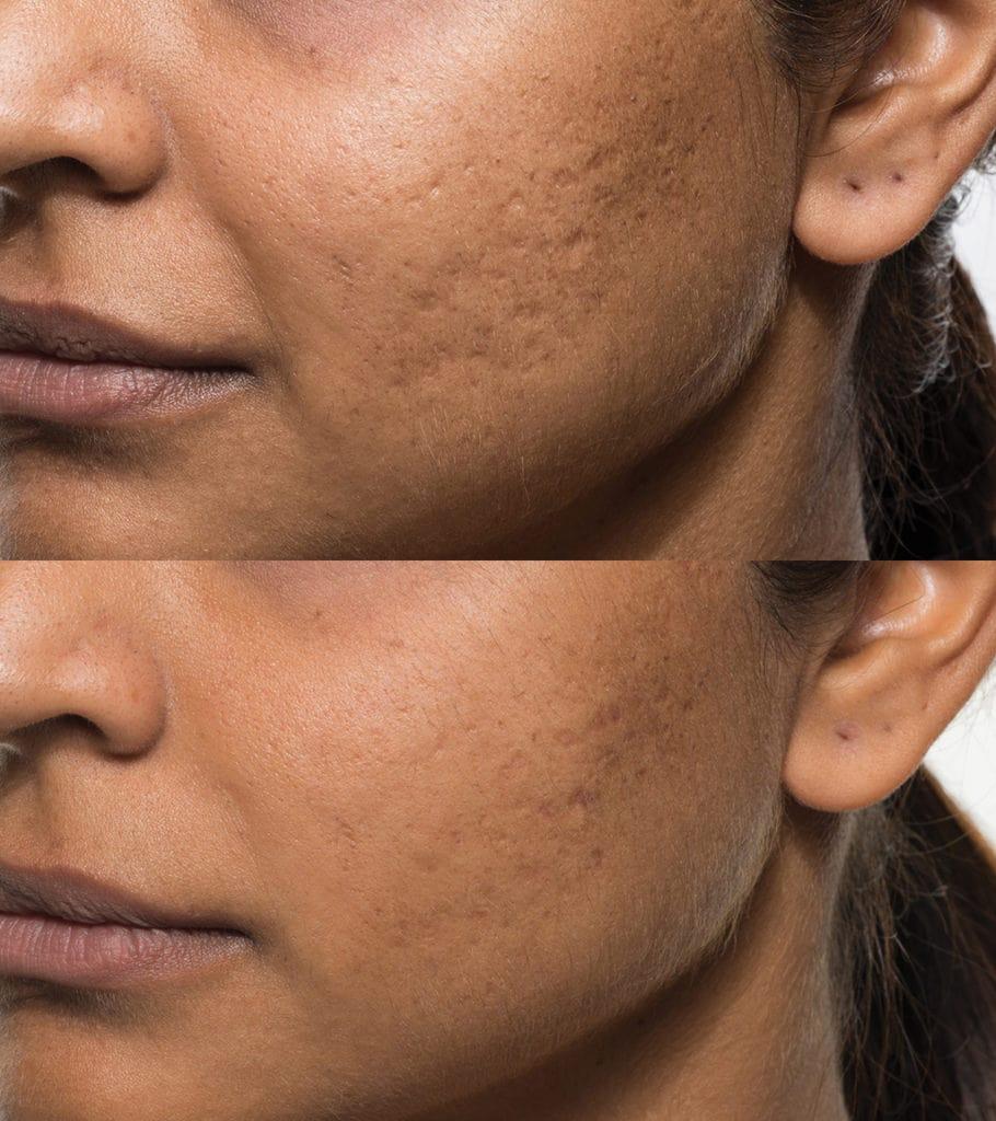 Bellafill Before After 1